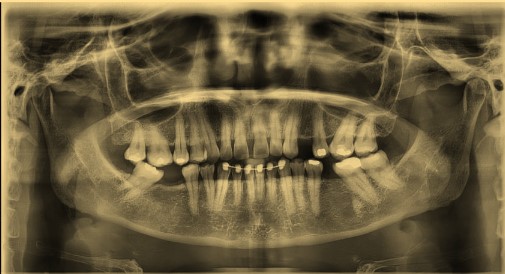 Flebolitos y Calcificaciones en Tejidos Blandos de Cabeza y&nbsp;Cuello