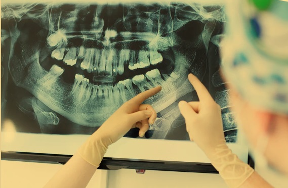 La inteligencia artificial revoluciona el diagnóstico dental a través del análisis de radiografías&nbsp;periapicales